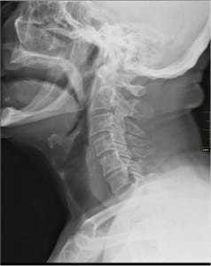 Throat X ray