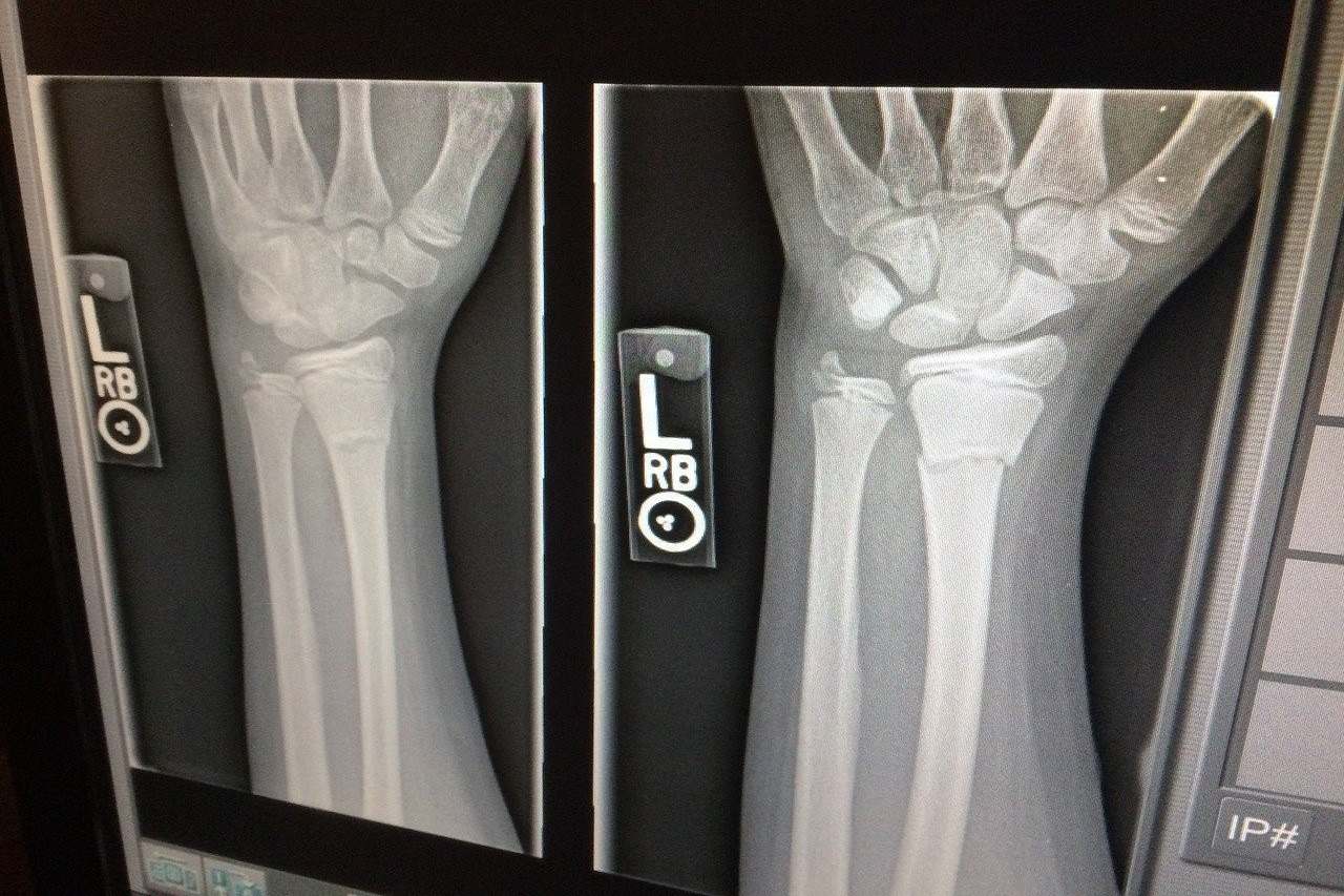 An x-ray of an injured wrist