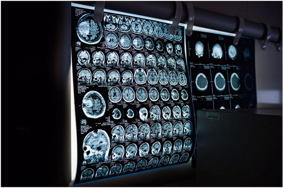 MRI Skull X Ray