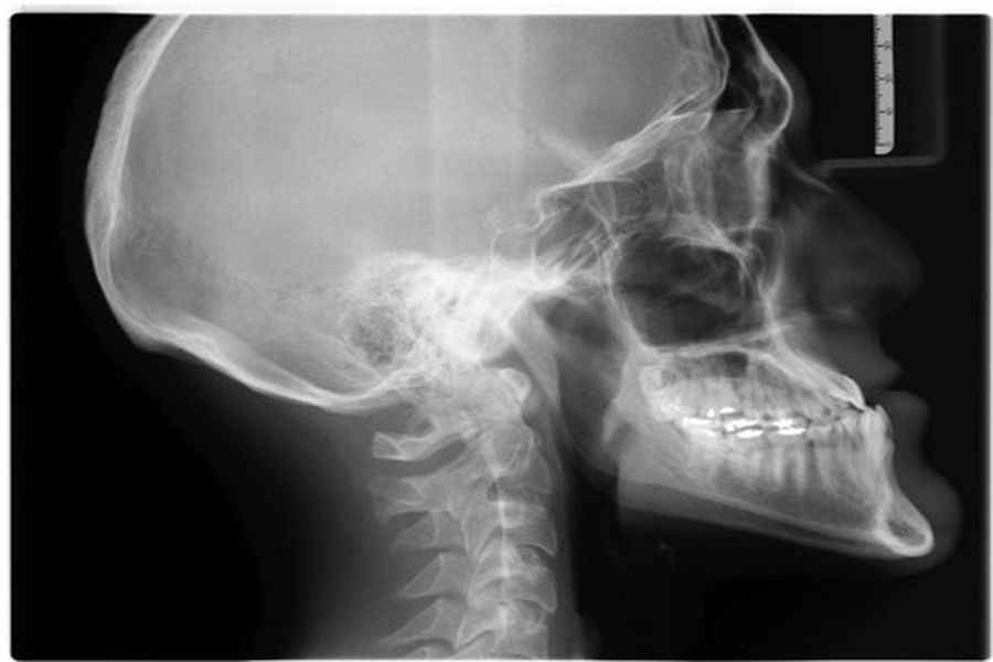 X-Ray of skull