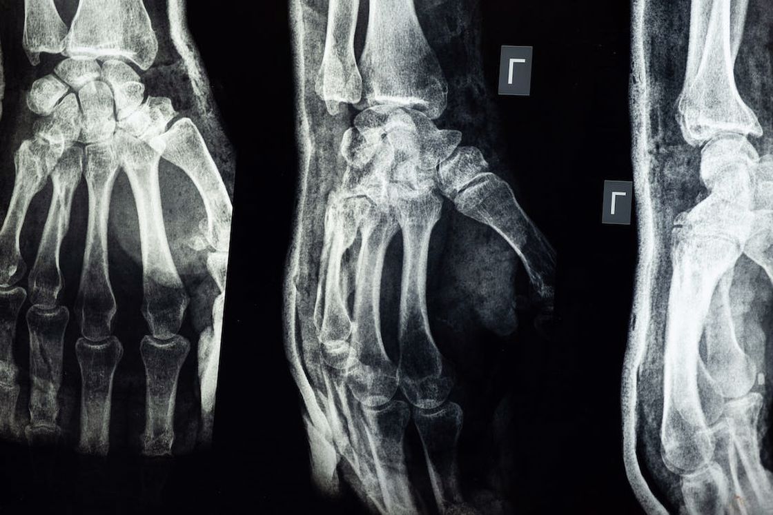 X-ray image of a hand fracture